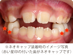 ネオキャップビムラー矯正は怖くない